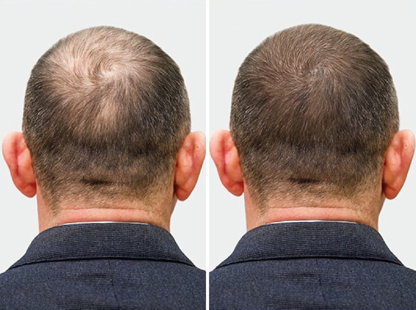 CAÍDA DEL CABELLO: Todo lo que necesitas saber para cuidar tu cabello